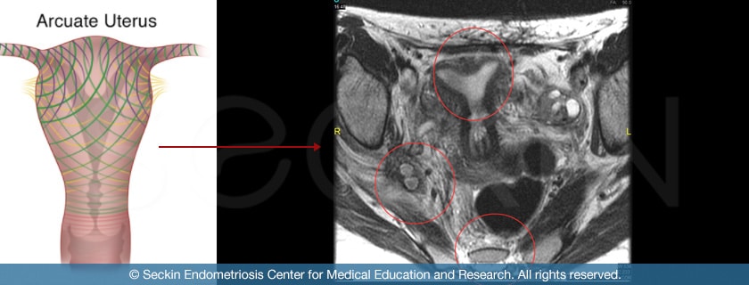 Arcuate uterus identified via MRI imaging.