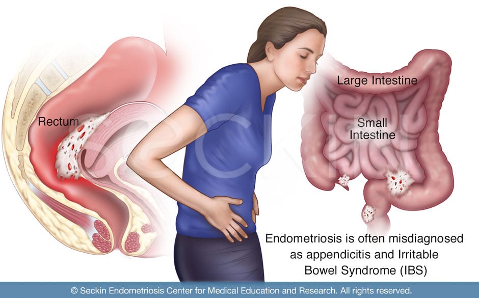 Patients with bowel endometriosis, which often masks itself as IBS