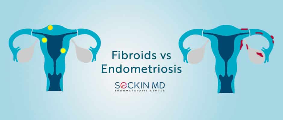 Fibroids vs Endometriosis
