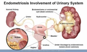 Can endometriosis affect the kidneys?