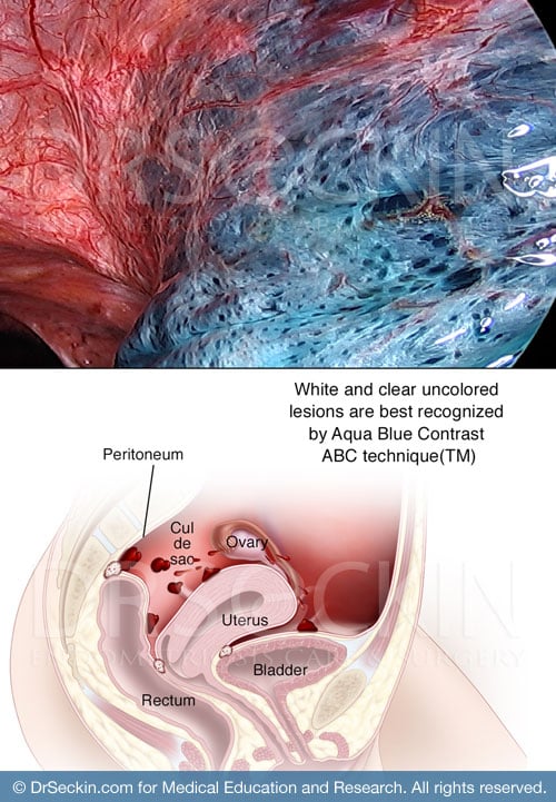 The Aqua Blue Contrast (ABC) technique is Seckin Endometriosis Centers' patented surgical method for identifying all endometriosis lesions that would be otherwise invisible to the naked eye.