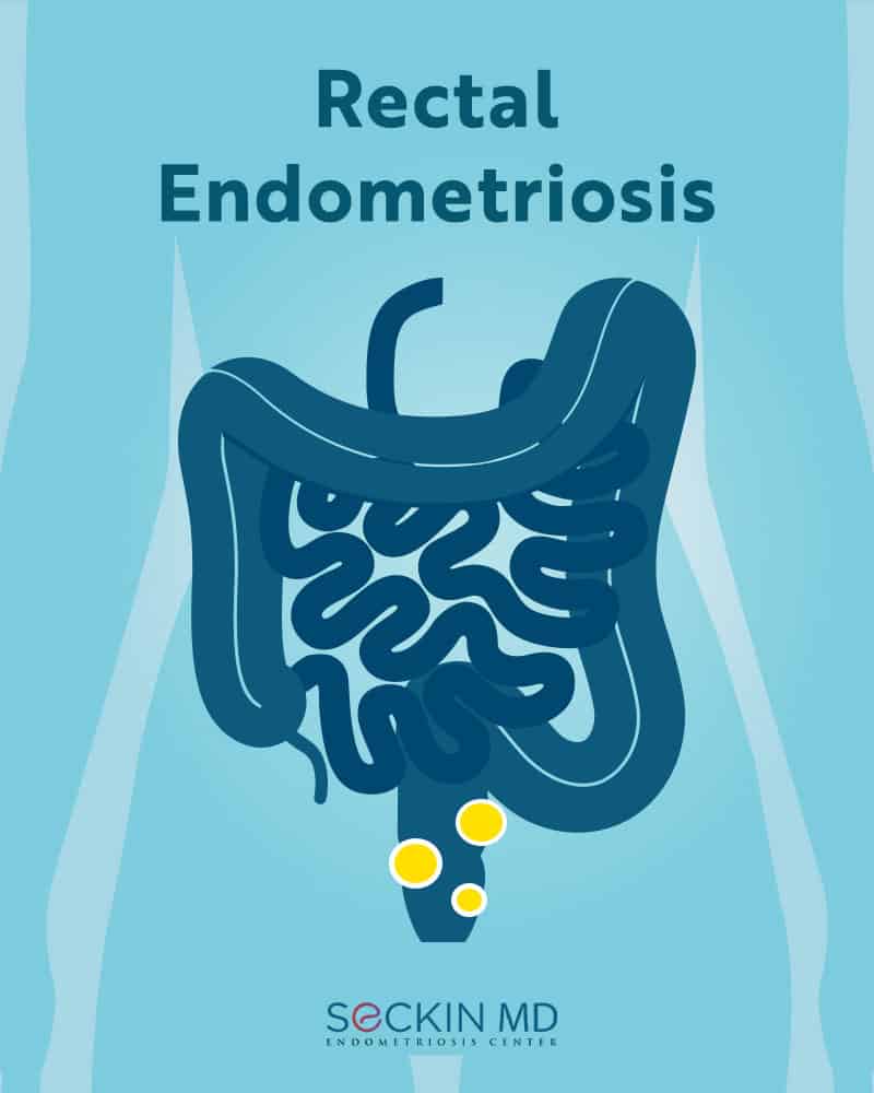 Rectal Endometriosis