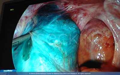 Peritoneum being filled with patented Aqua Blue Contrast.
