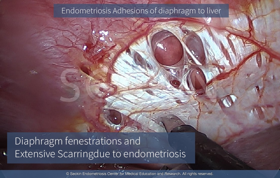 Thoracic Endometriosis Syndrome, Diaphragm fenestrations and  Extensive Scarringdue to endometriosis