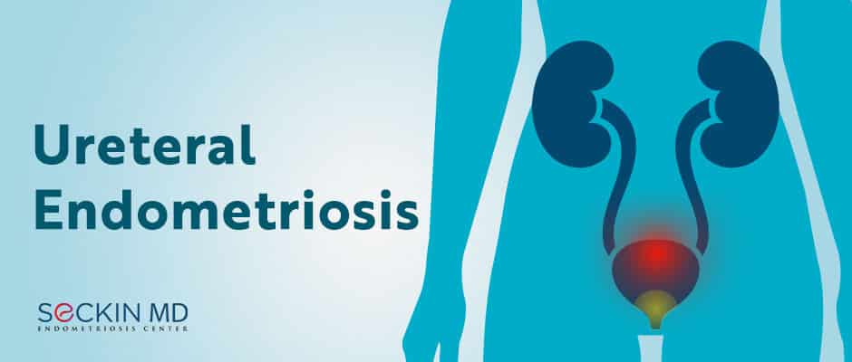 Ureteral Endometriosis