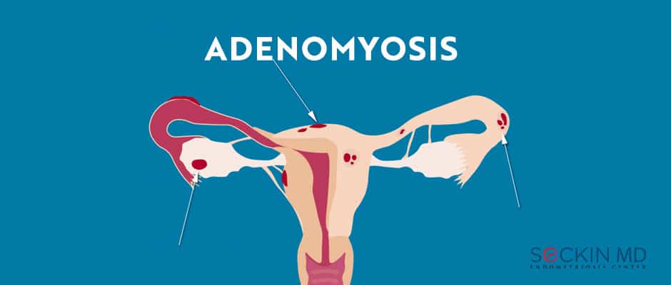 Symptoms adenomyosis Living With