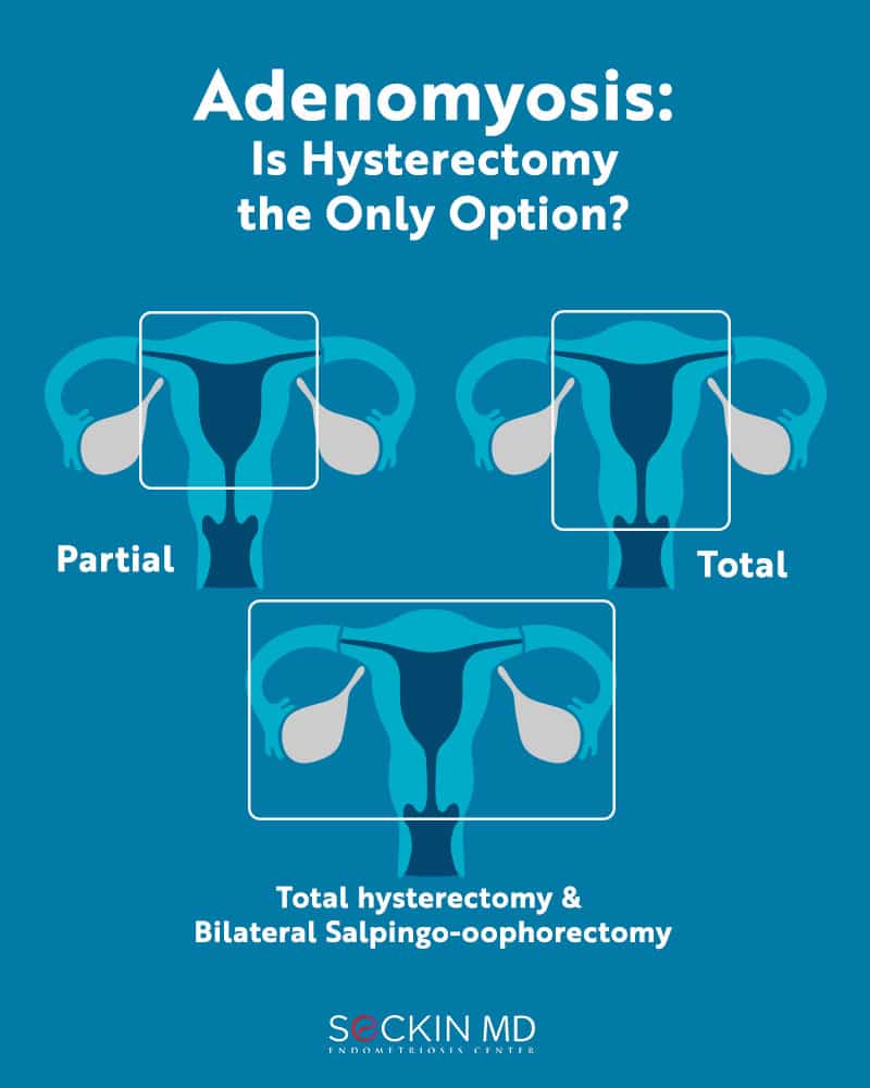 Adenomyosis: Is Hysterectomy the Only Option?