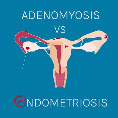 Endometriosis vs Adenomyosis