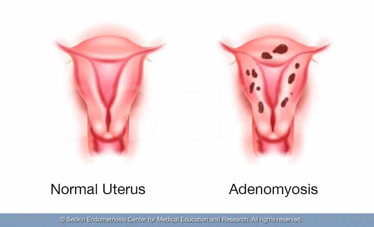 Normal uterus vs Adenomyosis