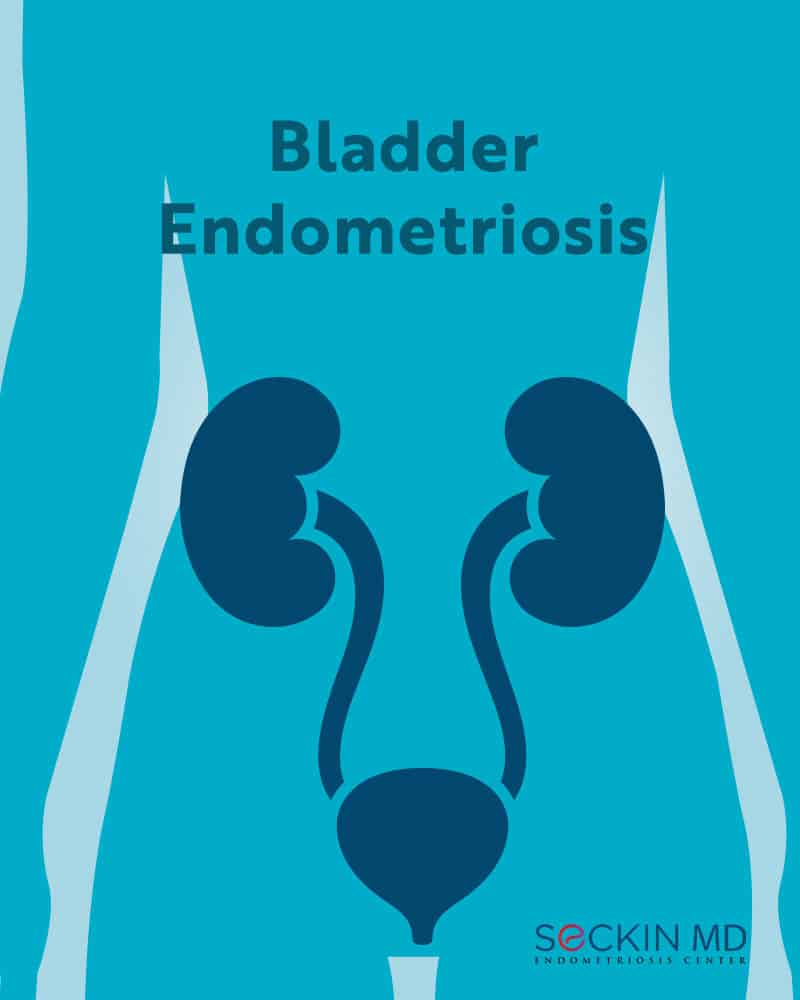 Bladder Endometriosis