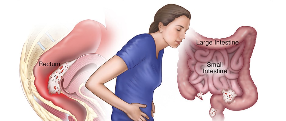 Bowel Endometriosis & IBS