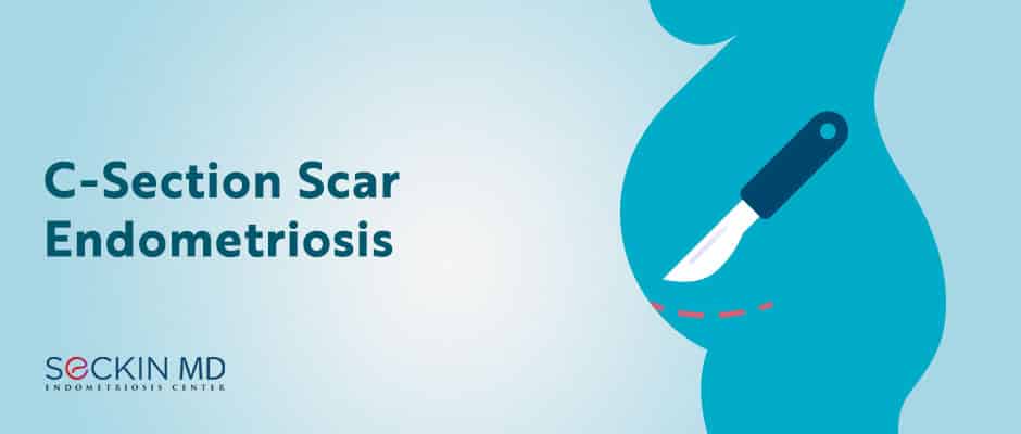 C-Section Scar Endometriosis