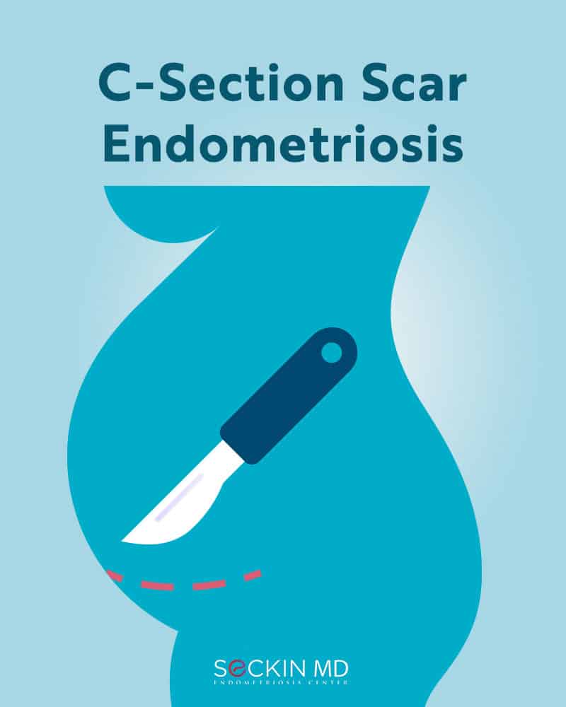 C-Section Scar Endometriosis