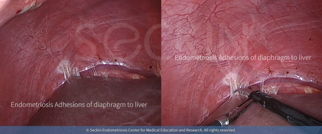 Endometriosis Adhesions of diaphragm to liver