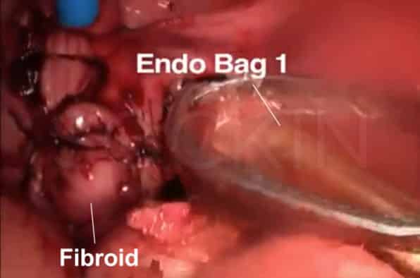 Intramural and subserosal fibroids