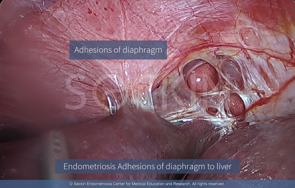 Endometriosis Adhesions of diaphragm to liver