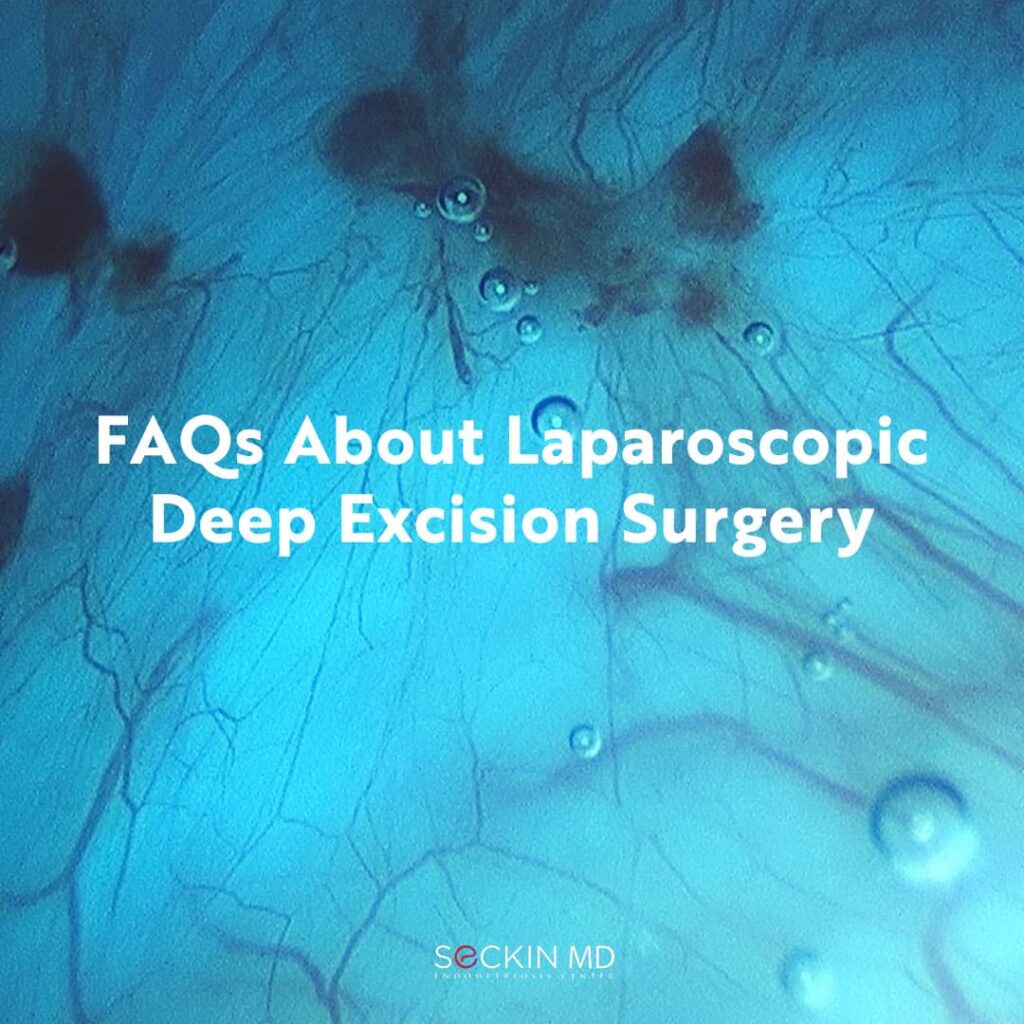 FAQs About Laparoscopic Deep Excision Surgery