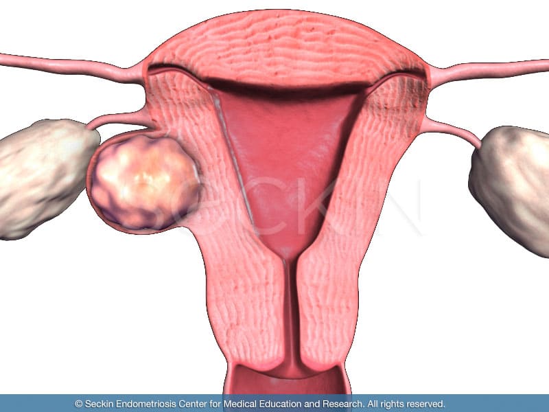 What is Fibroids