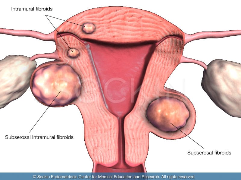 Several classifications of fibroids include intramural fibroids, subserosal intramural fibroids, and submucosal fibroids.
