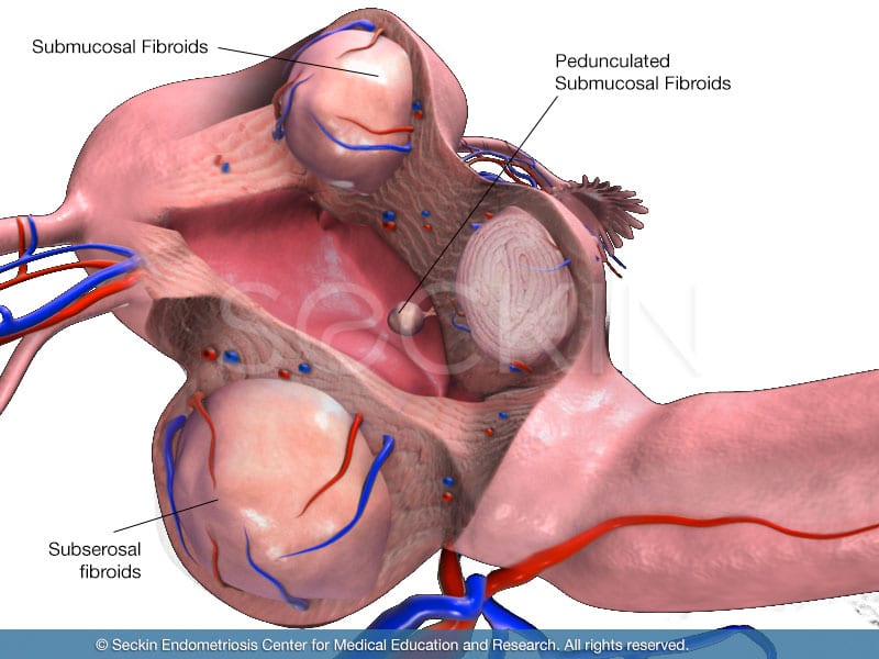 pedunculated fibroid, submucosal fibroid
