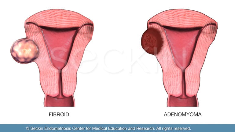 Adenomyoma and Fibroids