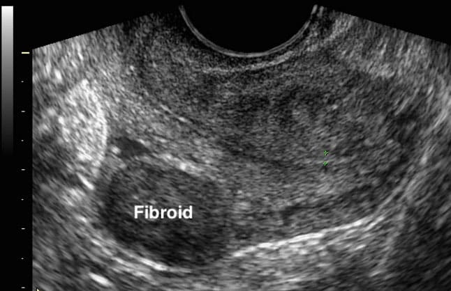 An US showing a fibroma, which is clearly seen as a dark mass upon imaging