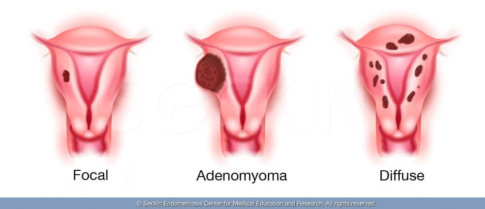 Focal adenomyosis, Adenomyoma, Diffuse adenomyosis