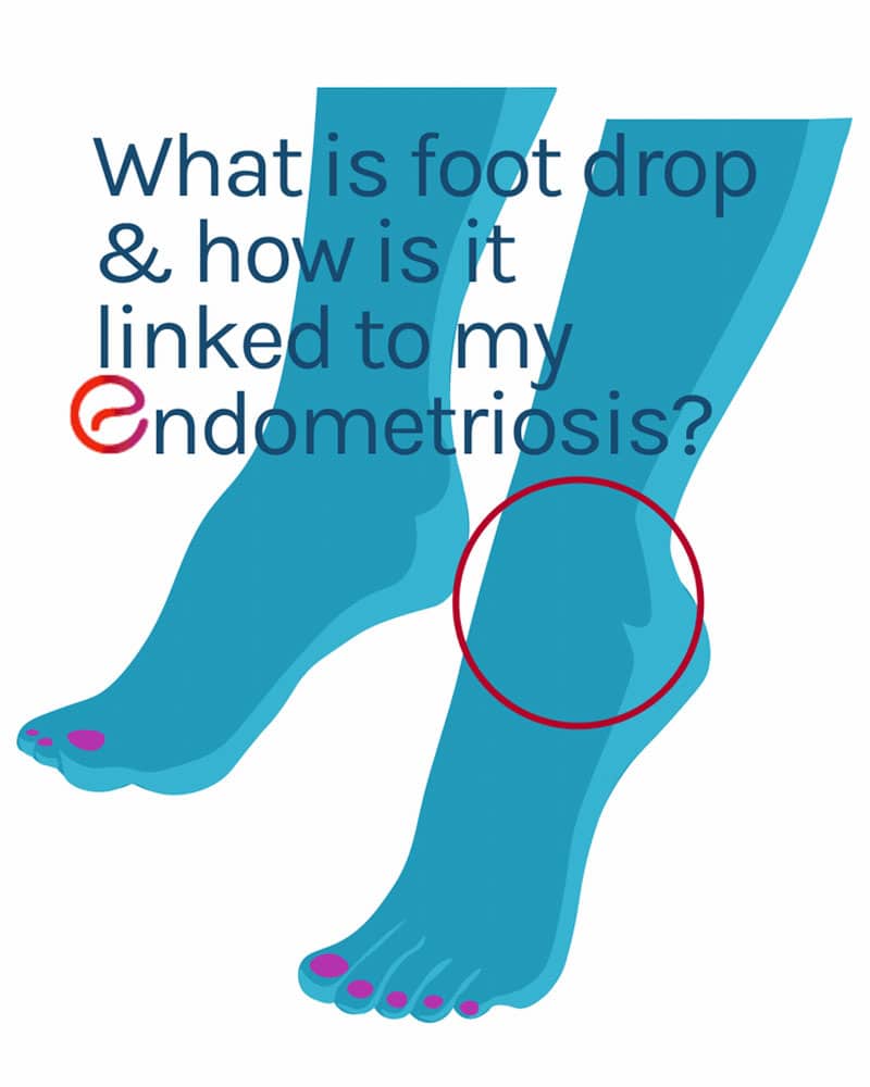 Foot Drop & Endometriosis