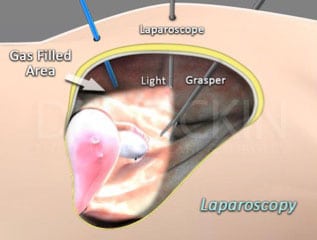 Laparoscopy entails visualization of the abdomen and pelvic cavity through an instrument known as the laparoscope