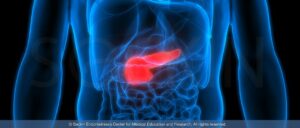 How does endometriosis affect the pancreas?