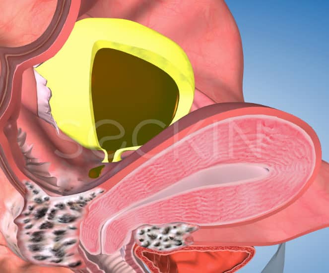 Ovarian Cysts and Pelvic Mass - Seckin Endometriosis Center