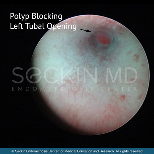 Polyp Blocking Left Tubal Opening