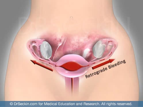 Retrograde menstruation lead to worsening endometriosis