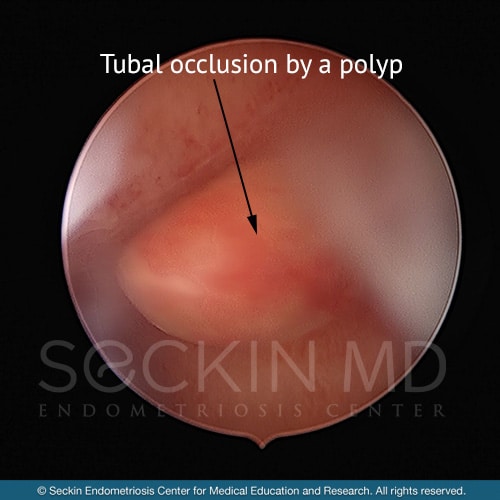 Tubal occlusion by a polyp