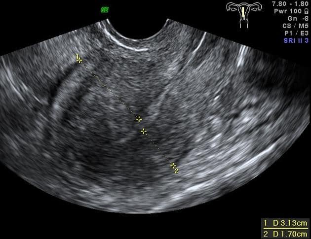 This ultrasound image of a patient with it depicts symmetric uterine wall thickening.