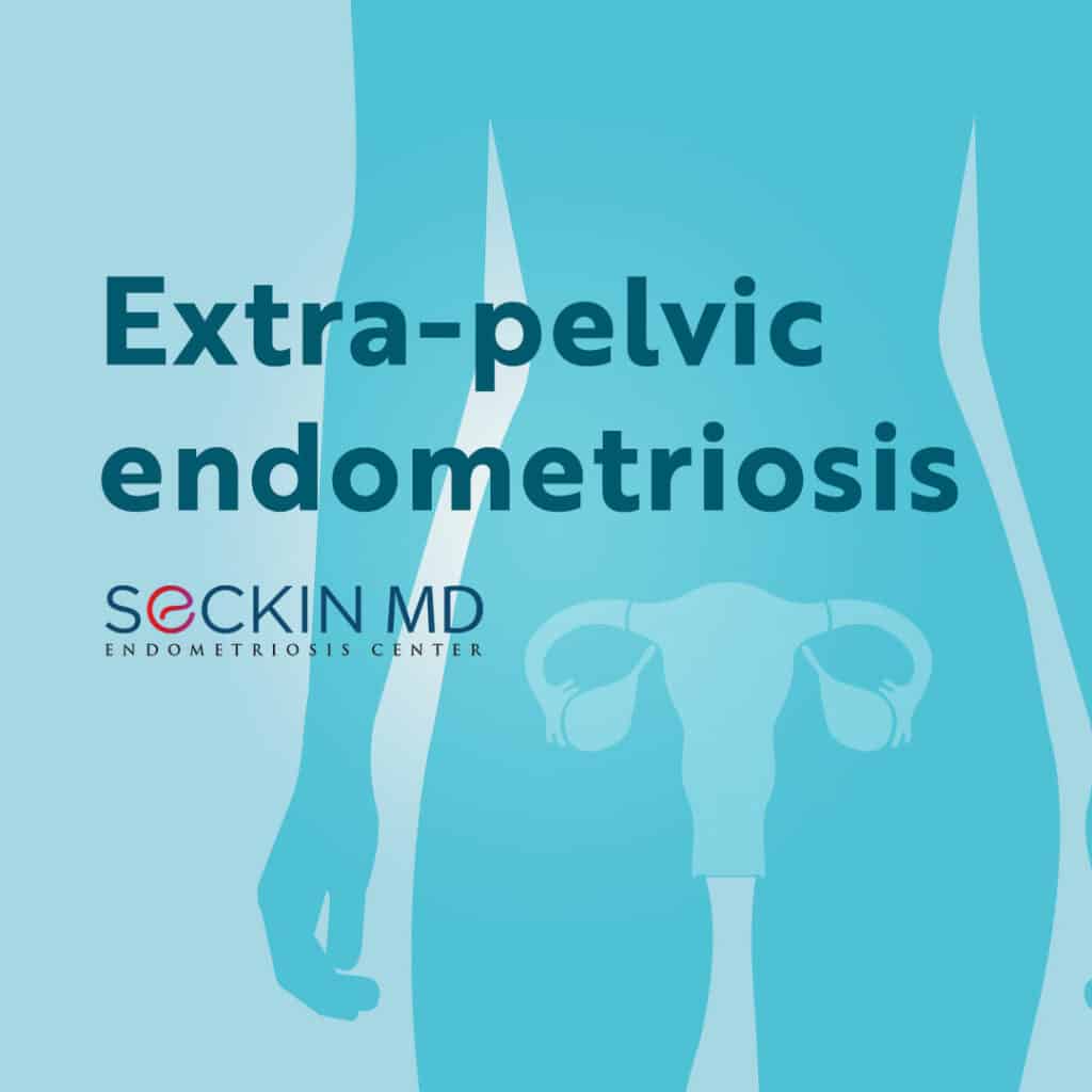Extra-pelvic endometriosis