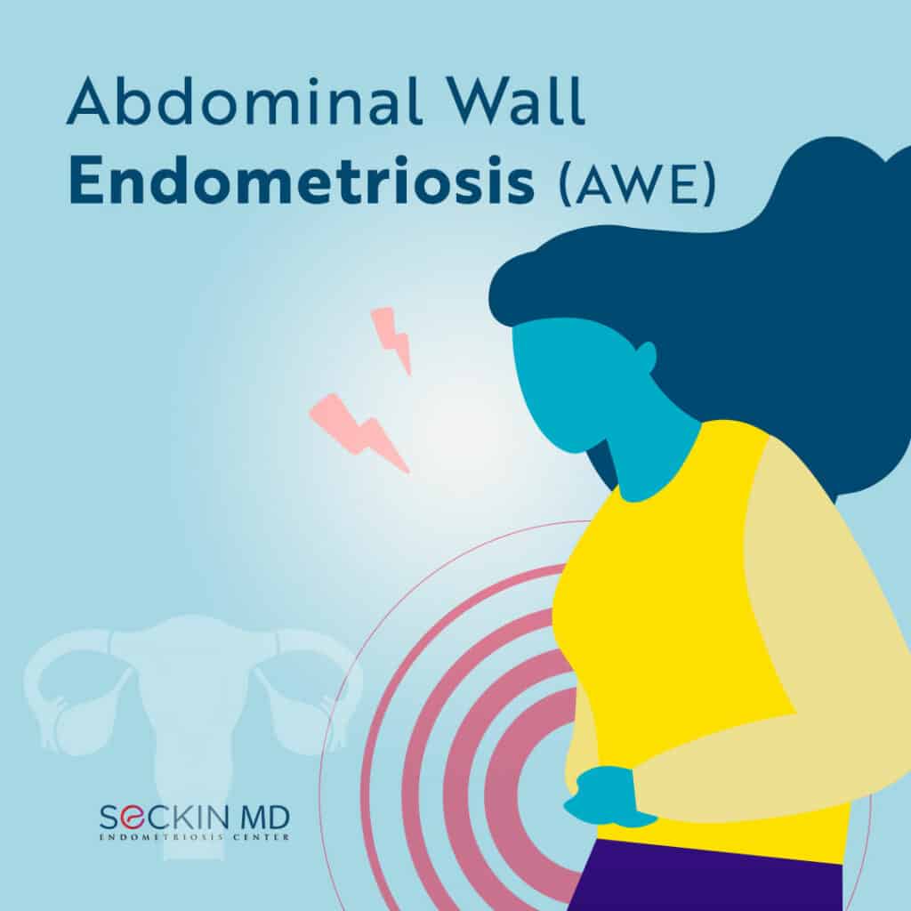 Abdominal Wall Endometriosis (AWE)