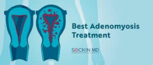 Best Adenomyosis Treatment