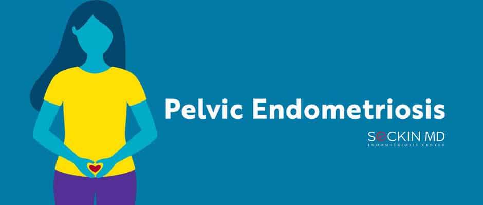 Pelvic Endometriosis