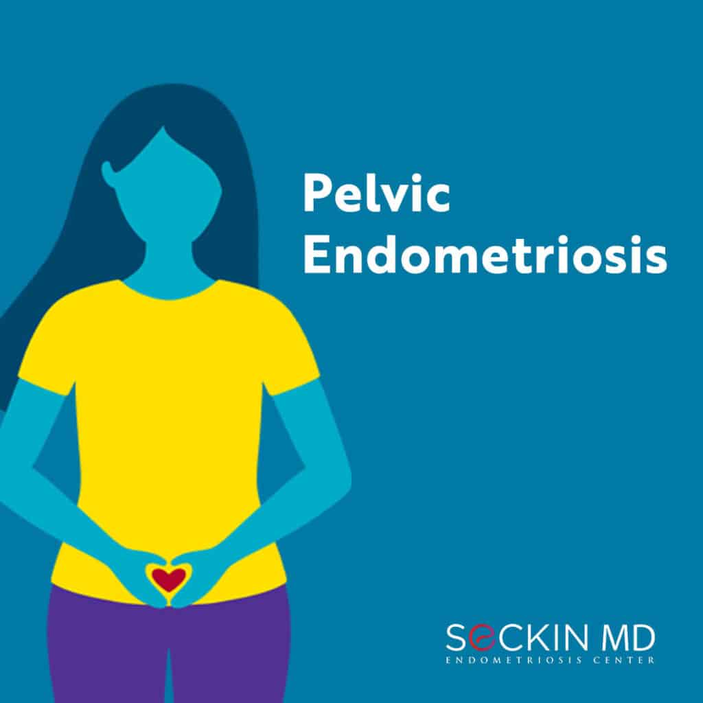 Pelvic Endometriosis