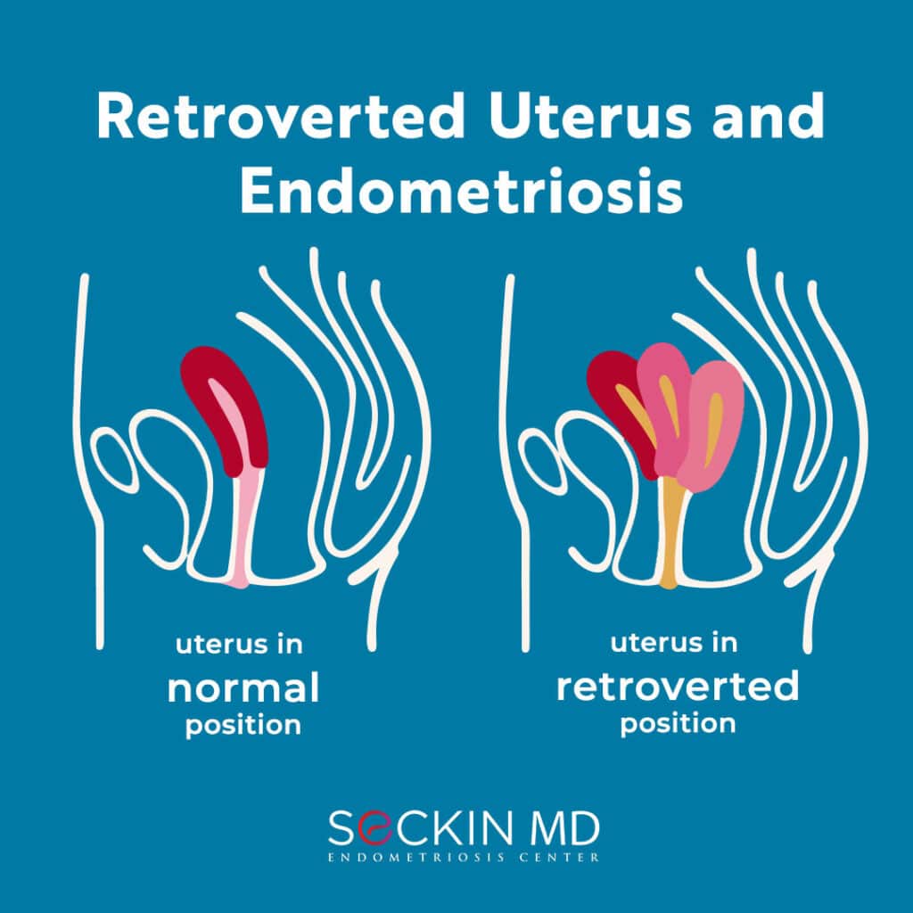 Retroverted or Tilted Uterus and Endometriosis image photo picture
