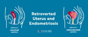 Retroverted Uterus and Endometriosis