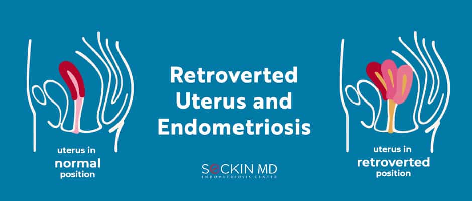 retroverted uterus