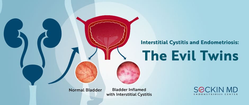 Interstitial Cystitis and Endometriosis: The Evil Twins