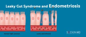 Leaky Gut Syndrome and Endometriosis