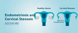 Endometriosis and Cervical Stenosis