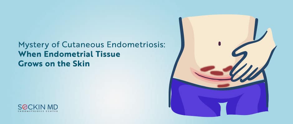 Mystery of Cutaneous Endometriosis: When Endometrial Tissue Grows on the Skin