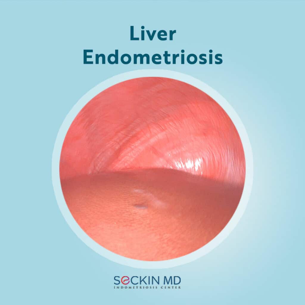 Liver Endometriosis