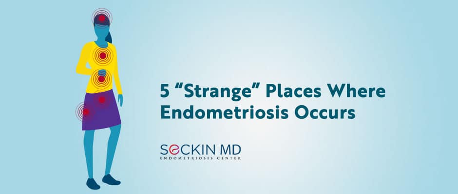 5 “Strange” Places Where Endometriosis Occurs