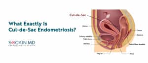 What Exactly Is Cul-de-Sac Endometriosis?